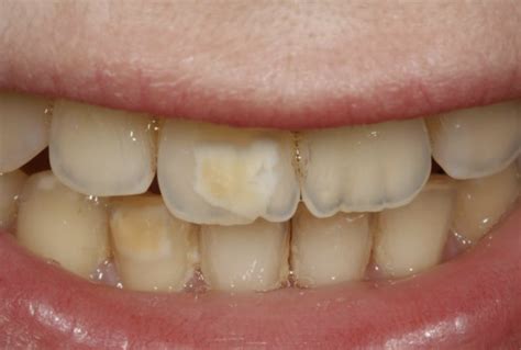 Brown and White Spots on Teeth: Micro-invasive Treatment