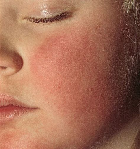 fifth disease rash pictures - pictures, photos