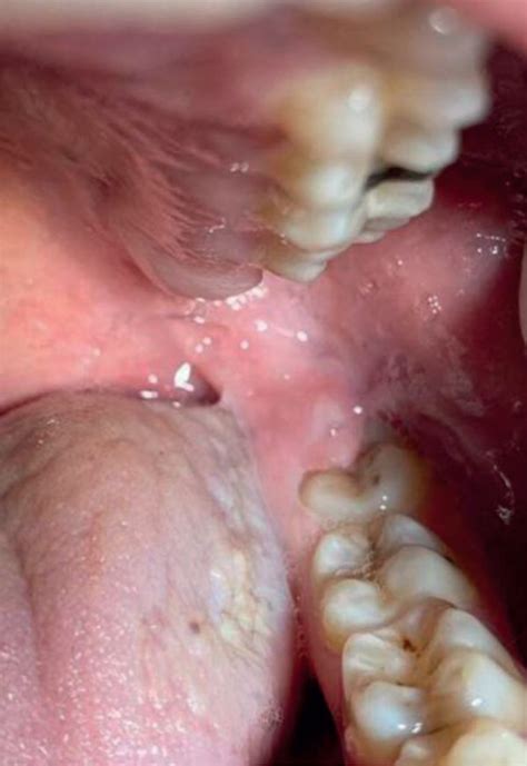 Clinical photograph showing a healthy semi-impacted third molar. | Download Scientific Diagram