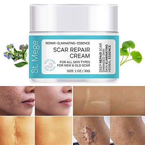 Outrageous Tips About How To Prevent Scars From Burns - Unfuture38