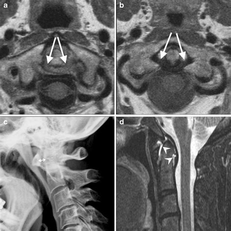 MRI of the transverse and alar ligaments in rheumatoid arthritis: feasibility and relations to ...