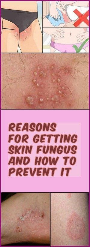 Reasons For Getting Skin Fungus And How To Prevent It | Fungus skin, Prevention, Natural beauty ...