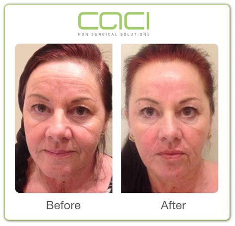 CACI non-surgical facelifts in Preston at Be Beautiful Salon