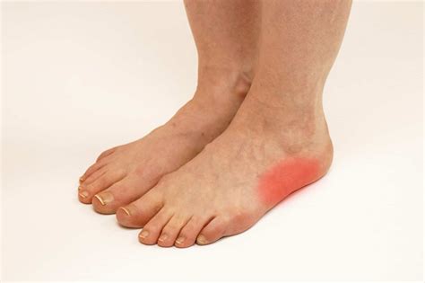 Cuboid Syndrome: Causes, Symptoms, and How a Chiropodist Can Help ...