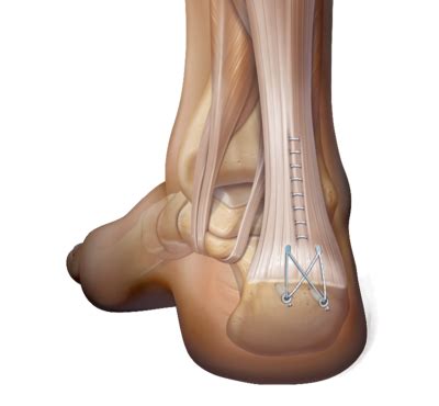 Achilles Tendon Reconstruction — Chicago Foot & Ankle Orthopaedic Surgeons