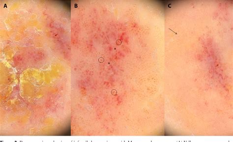 Figure 1 from An Unusual Case of Meyerson Phenomenon Around Infantile Hemangioma. | Semantic Scholar