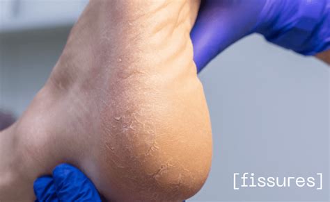 Heel Fissures Treatment and Home Care Tips | Dérmica, Edmonton, AB.