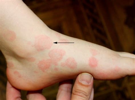 How may coronavirus symptoms (COVID-19) manifest on the skin? - Online AI Dermatologist