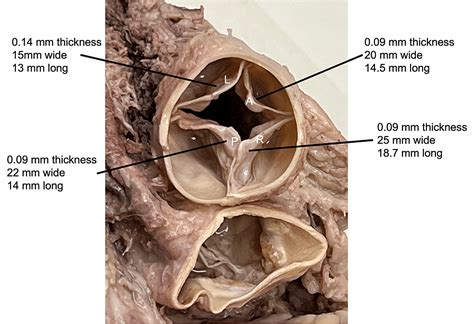 Cureus | Quadricuspid Pulmonary Valve With Fenestration: Cadaveric Findings