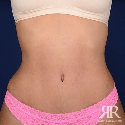 Belly button discharge after tummy tuck - Cosmetic Surgery Tips