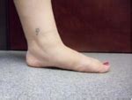 Flat Feet Can Cause Piriformis Syndrome - Dr. Don Kim