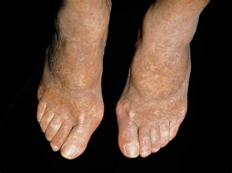 Peripheral Arterial Disease Feet
