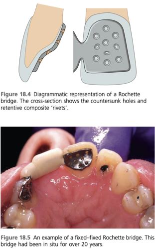 Crown and Bridge 10 - Resin Retained Bridges Flashcards | Quizlet