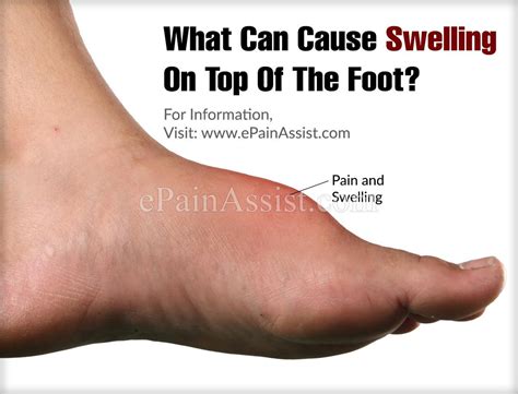 What Can Cause Swelling On Top Of The Foot? | Swelling feet, Swollen feet remedy, Swellings