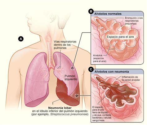 Neumonía | NHLBI, NIH