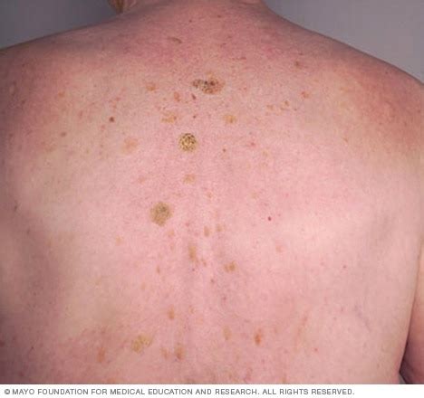 Seborrheic keratosis - Symptoms & causes - Mayo Clinic