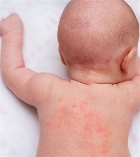 Baby Heat Rash: Types, Symptoms And Treatment