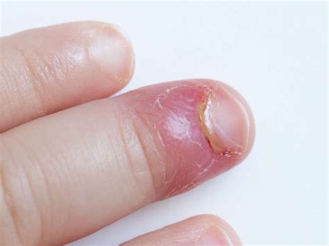 Paronychia is the medical term for an infection in the skin around the nail, which becomes ...