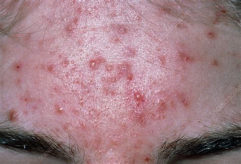 Acne vulgaris on forehead - Stock Image - M108/0333 - Science Photo Library