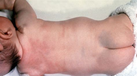 Blue-grey birthmarks (Congenital dermal melanocytosis)