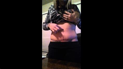 Week 3: Post op tummy tuck - YouTube