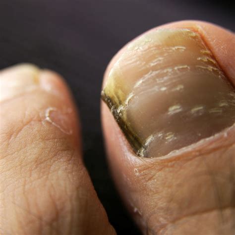 What is Black Toenail Fungus? – Forces of Nature Medicine
