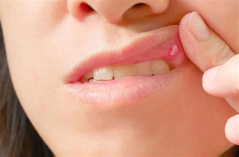 Oral Stomatitis – Causes, Types of Stomatitis – Prevention and treatment