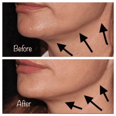 Can Botox Lift Jowls? - SCULPTDTLA.COM