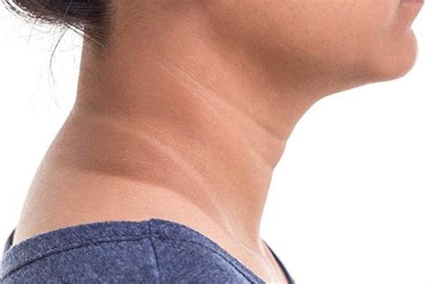 Acanthosis Nigricans Neck