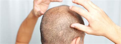 Causes of Hair Loss: Central Centrifugal Cicatricial Alopecia and Frontal Fibrosing Alopecia ...