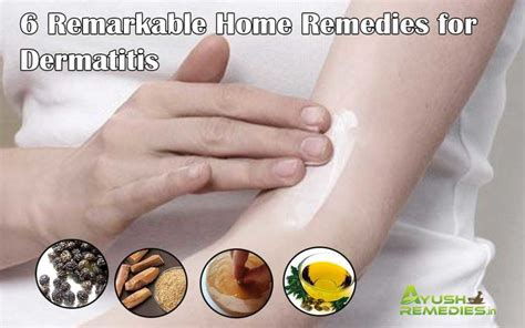 6 Home Remedies for Dermatitis on Face, Scalp and Hands