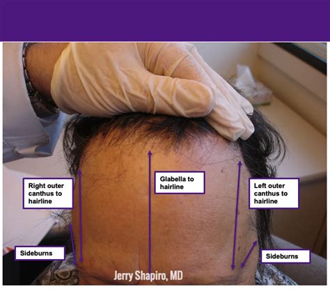 Lichen Planopilaris and Frontal Fibrosing Alopecia: Treatment Algorithms - Next Steps in Dermatology