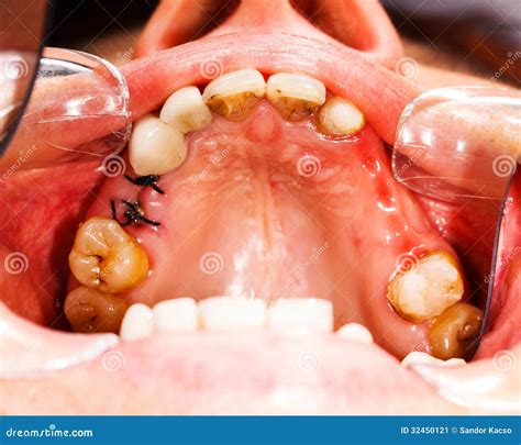 Stitches After Dental Extraction Stock Photo | CartoonDealer.com #32450121