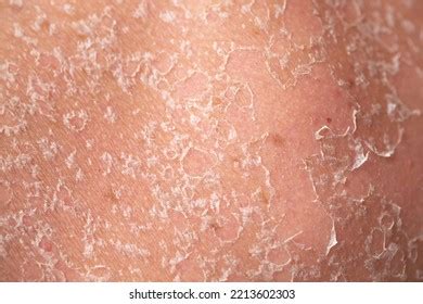 Sunburn Close-up Human Skin Flaky Skin Stock Photo 2234772067 ...