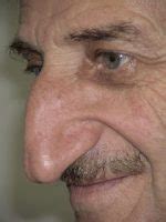 Mehmet Ozyurek-Longest nose in the world