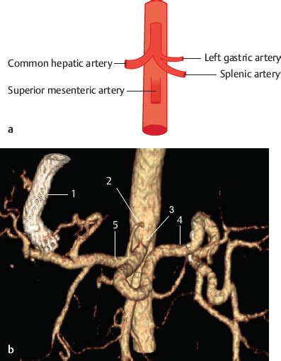 Celiac Trunk | Radiology Key