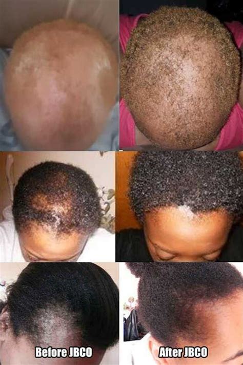 biotin hair growth before and after pictures male - Kathey Fuentes