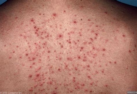 folliculitis rash - pictures, photos