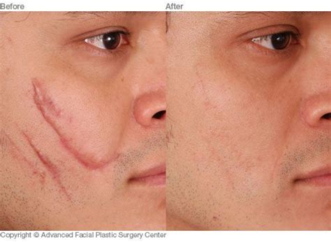 Scar removal plastic surgery