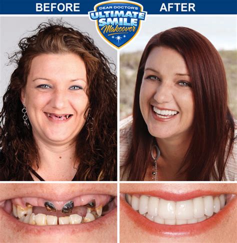 Extreme Makeover Before And After Teeth