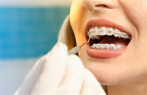 How Do Braces Fix an Overbite | O'Gara-Gilbert-Silvaroli Orthodontics