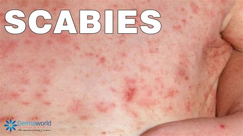 Scabies Causes And Risk Factors - vrogue.co