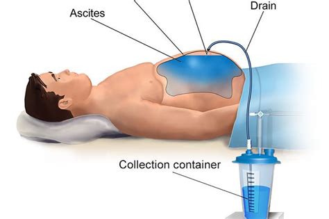 Ultrasound-Guided Paracentesis Procedure - SIFSOF