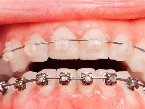 Ceramic Braces vs Metal Braces: Which is Better?