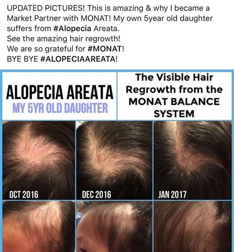 Do you suffer from Alopecia? Here are real results with Monat. No harmful chemicals. Look at ...