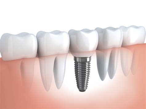 What to Expect after Dental Implant Surgery |Cosmetic Dentistry ...