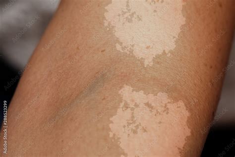 A closeup view on the arm of a person suffering from tinea versicolor, a fungal infection of ...