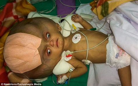 Boy with 'world's largest head' has operation to drain 3.7 LITRES of ...