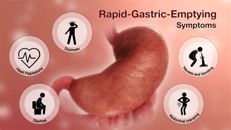 Rapid Gastric Emptying Symptoms Shown Using Medical Animation
