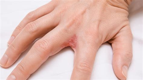 Dyshidrotic Eczema Small Bumps On Hands: Causes, Treatments, Symptoms ...